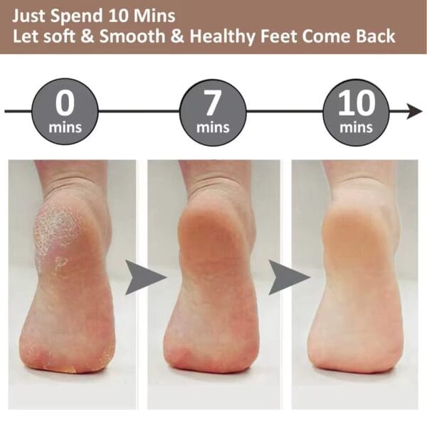 Just Spend 10 Minutes Electric Callus Remover